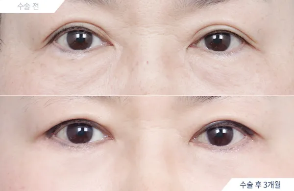 Before/After