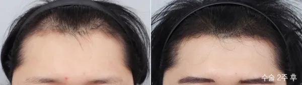 Before/After
