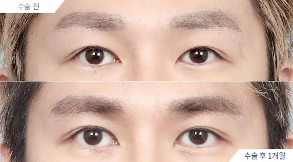 Before/After