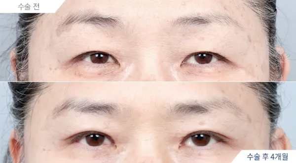 Before/After