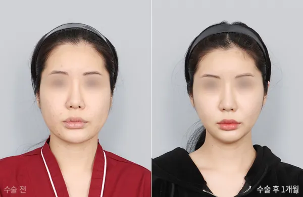Before/After
