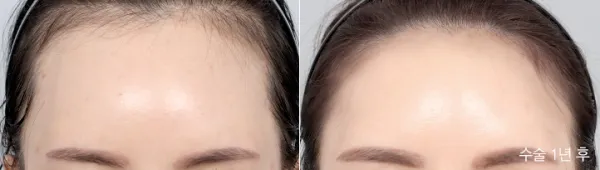 Before/After