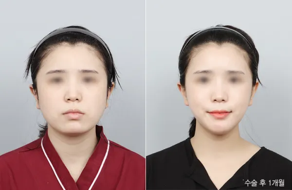 Before/After