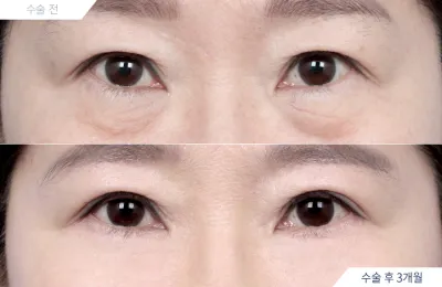 Before & After