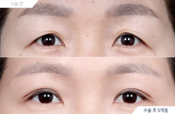 Before/After