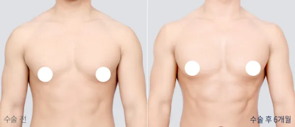 Before/After