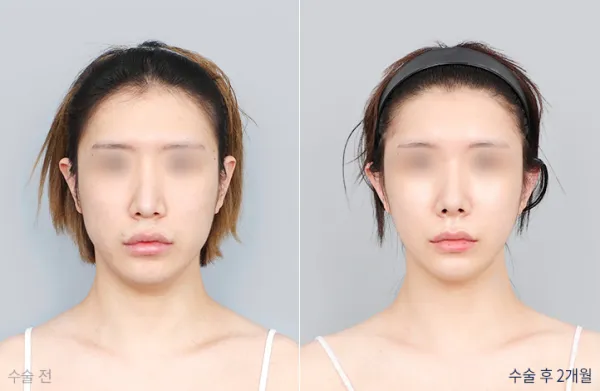 Before/After