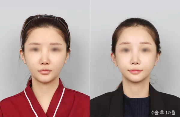 Before/After