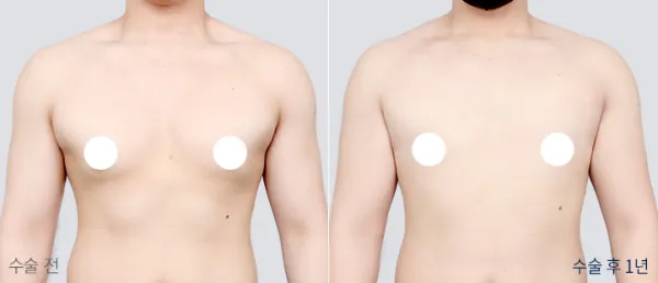 Before/After