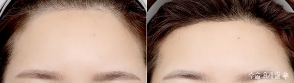 Before/After