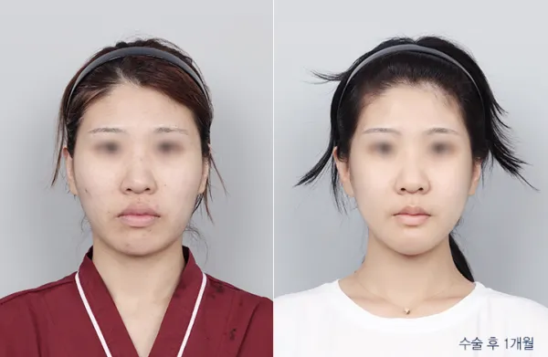 Before/After