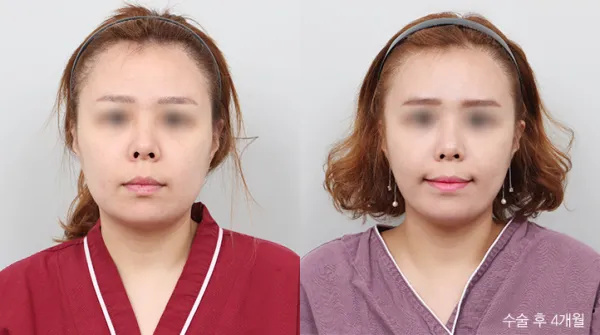 Before/After