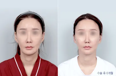 Before & After