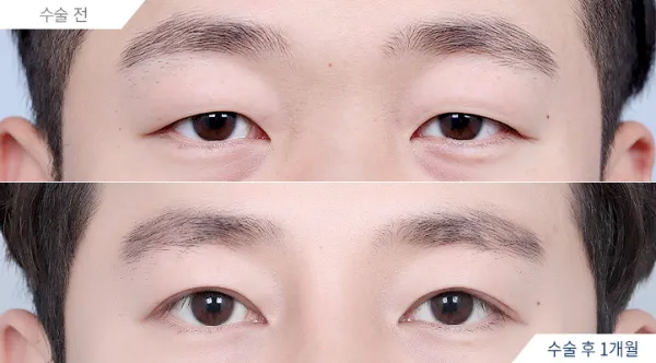 Before/After