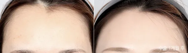 Before/After