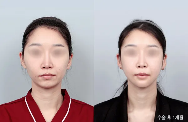 Before/After