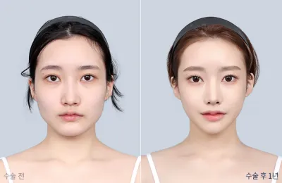 Before & After