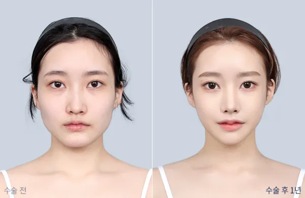 Before/After