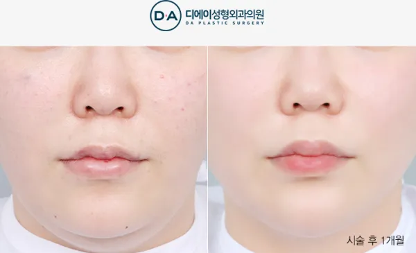 Before/After