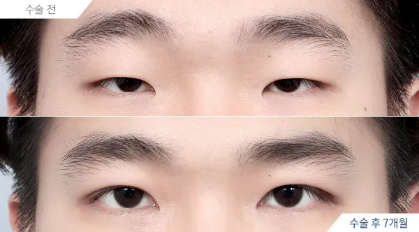 Before/After