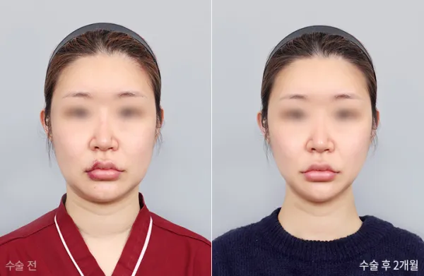 Before/After