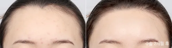 Before/After