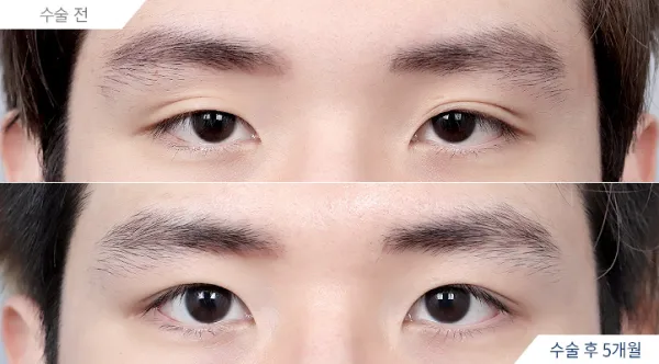 Before/After