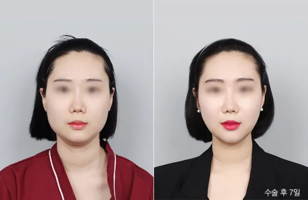 Before/After