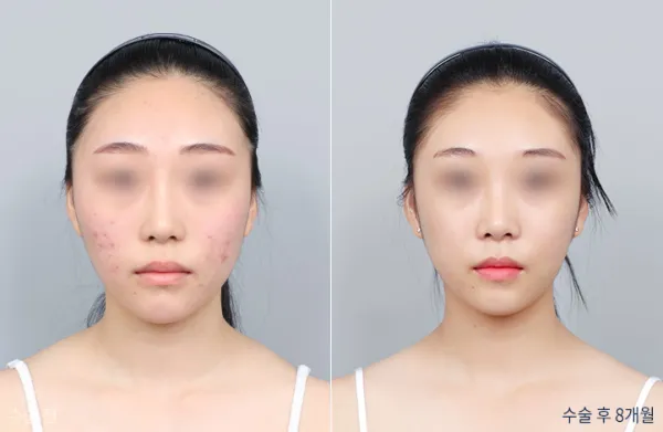 Before/After