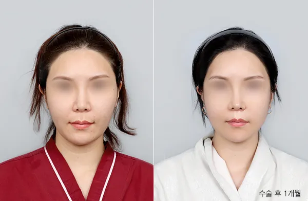 Before/After