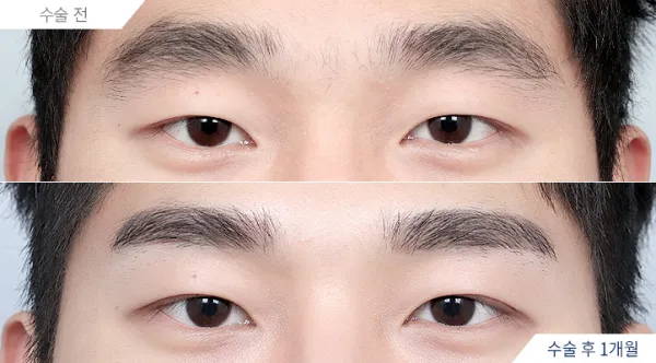 Before/After