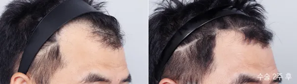 Before/After