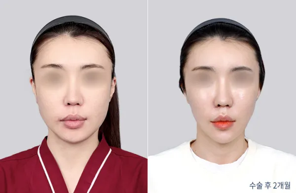 Before/After