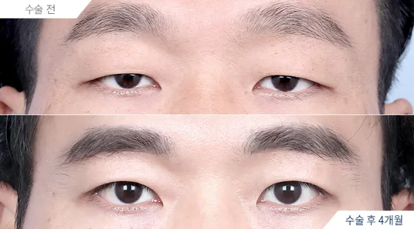 Before/After