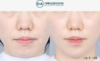 Before & After