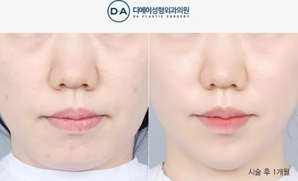 Before/After