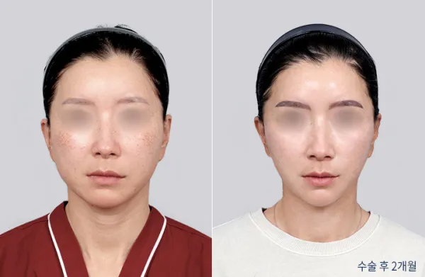 Before/After