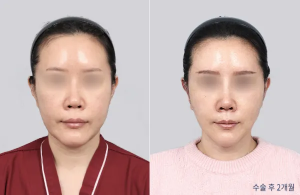 Before/After