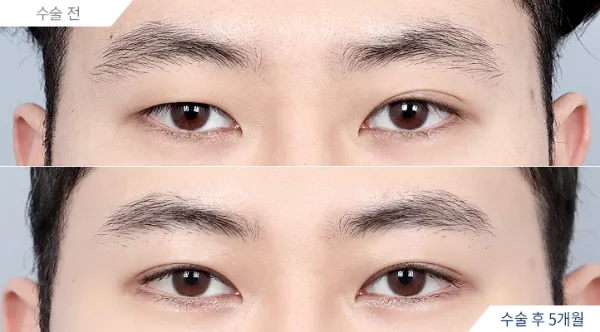 Before/After