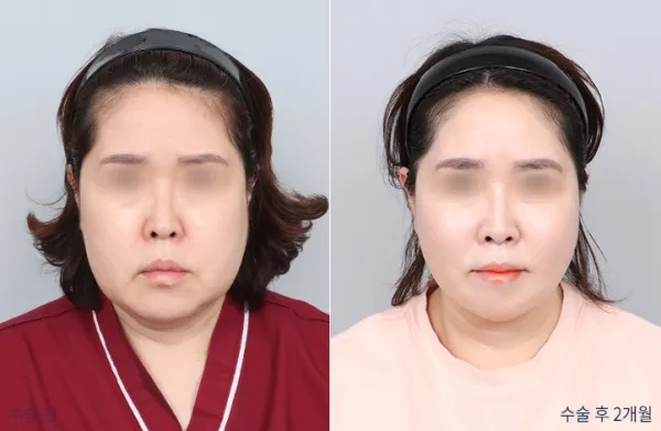 Before/After