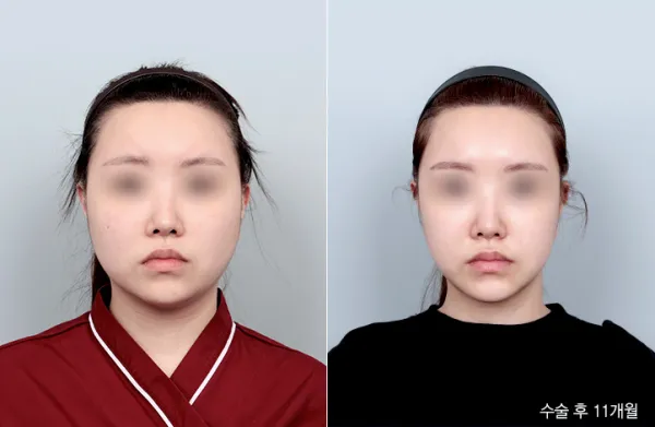 Before/After