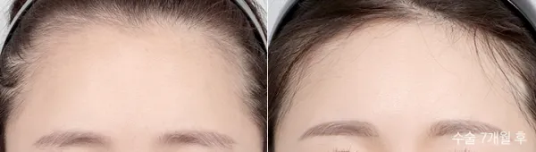 Before/After