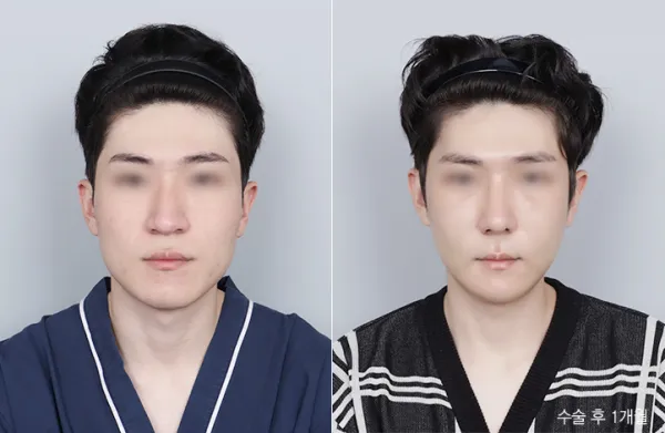 Before/After