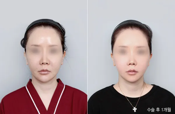 Before/After
