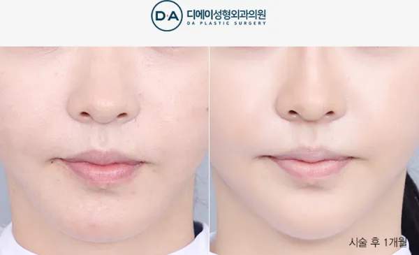 Before/After