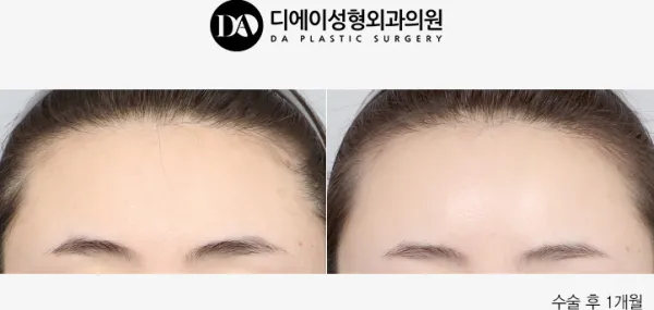 Before/After