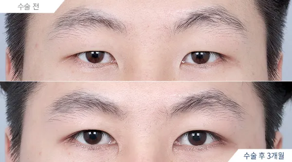 Before/After