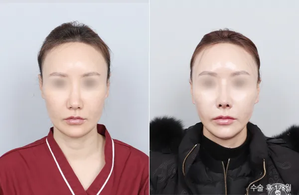 Before/After