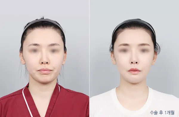 Before/After