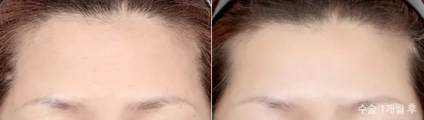 Before/After
